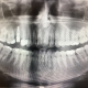 After dental implantation