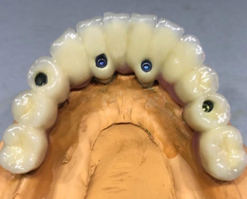 All-on-4 dentures
