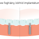 teljes fogív pótlása fogászati implantátummal
